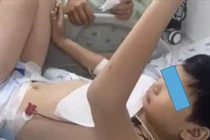 Đau đầu gối sau chơi cầu lông, trẻ 10 tuổi thuyên tắc mạch máu não nguy kịch