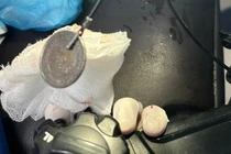 Trắng đêm cứu trẻ nuốt đồng xu thép 3 cm vào thực quản