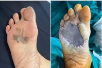 Phát hiện sớm ung thư da từ vết đen lâu năm trên bàn chân