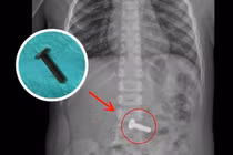 Trẻ 4 tuổi ho và nôn, không ngờ nuốt phải đinh vít hơn 3cm