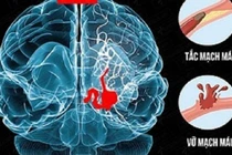 Suy giảm nhận thức sau đột quỵ, vấn đề phổ biến nhưng bị bỏ sót