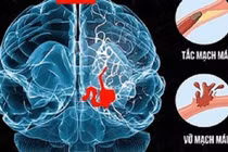 Suy giảm nhận thức sau đột quỵ, vấn đề phổ biến nhưng bị bỏ sót