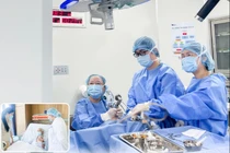 Laser CO2 vi phẫu qua đường miệng điều trị ung thư dây thanh