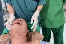 Kỹ thuật cao đặt nội khí quản cho bệnh nhân mất toàn bộ xương hàm