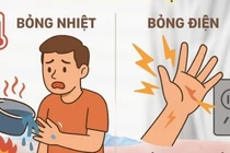 Nhiều ca bỏng nặng do sinh hoạt, người dân cần biết cách sơ cứu