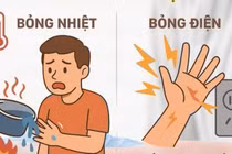 Nhiều ca bỏng nặng do sinh hoạt, người dân cần biết cách sơ cứu