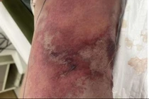 Địa chỉ vàng: Bệnh viện điều trị tốt bệnh “vi khuẩn ăn thịt người”