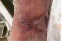 Địa chỉ vàng: Bệnh viện điều trị tốt bệnh “vi khuẩn ăn thịt người”