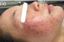 Mảng đỏ trên mặt, cẩn thận bệnh trứng cá đỏ