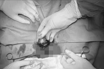 Trẻ 15 tuổi phải cắt bỏ tinh hoàn tím đen vì đau nhẹ bìu gia đình chủ quan