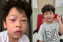 Trẻ 5 tuổi phù mạch sau 30 phút chơi "chất nhờn ma quái"