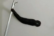 Con đỉa 4 cm sống ký sinh trong mũi bệnh nhi ở Quảng Trị