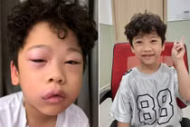 Trẻ 5 tuổi phù mạch sau 30 phút chơi "chất nhờn ma quái"