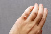 Mụn hạt cơm, tổn thương nhỏ, cẩn thận lây nhiễm, ung thư