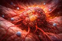 Dấu hiệu khối u ác tính nhiều người bỏ qua, tưởng chỉ là mệt mỏi thông thường