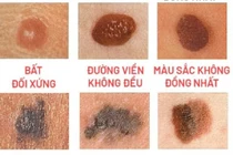 Cắt nốt ruồi bỏ qua xét nghiệm mô bệnh học cẩn thận ung thư