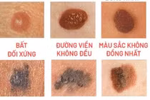 Cắt nốt ruồi bỏ qua xét nghiệm mô bệnh học cẩn thận ung thư