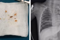 Hóc kẹo lạc, trẻ 17 tháng tuổi ngừng tim nguy kịch