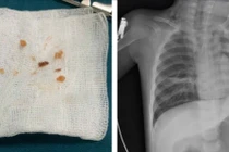 Hóc kẹo lạc, trẻ 17 tháng tuổi ngừng tim nguy kịch