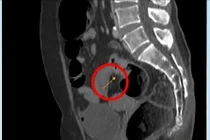 Tưởng ngộ độc thực phẩm, khám phát hiện ung thư trực tràng