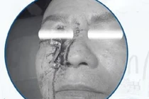 Người đàn ông bị dị vật kim loại lớn đâm xuyên vùng hốc mắt