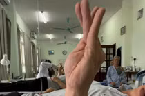 Ngủ gật gối đầu lên tay, người đàn ông 37 tuổi bị liệt thần kinh quay