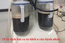 Hút 10 lít dịch trong u buồng trứng của cô gái 23 tuổi