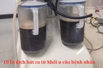 Hút 10 lít dịch trong u buồng trứng của cô gái 23 tuổi