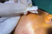 Người phụ nữ bị biến chứng sau dao kéo tạo má lúm đồng tiền