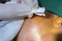 Người phụ nữ bị biến chứng sau dao kéo tạo má lúm đồng tiền