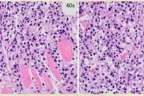 Đau lưng âm ỉ tưởng thoái hóa tuổi già không ngờ u cột sống