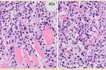 Đau lưng âm ỉ tưởng thoái hóa tuổi già không ngờ u cột sống