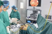 Lấy sỏi tái phát cho người tiền sử 3 lần phẫu thuật ổ bụng phức tạp