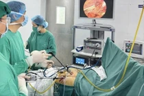 Lấy sỏi tái phát cho người tiền sử 3 lần phẫu thuật ổ bụng phức tạp