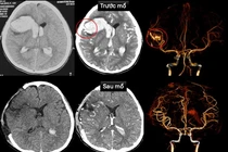 Trẻ 13 tuổi vỡ dị dạng mạch máu não trên nền bệnh cơ tim xốp