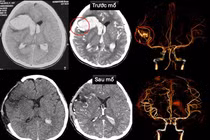 Trẻ 13 tuổi vỡ dị dạng mạch máu não trên nền bệnh cơ tim xốp