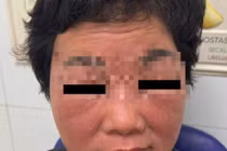 Bôi thuốc gia truyền làm trắng, người phụ nữ bị đỏ da, bong vảy toàn bộ mặt