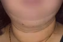 Tự ý dùng thuốc, người phụ nữ bị hội chứng Cushing nguy hiểm