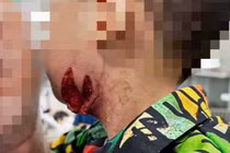 Nghỉ hè về quê, trẻ hơn 2 tuổi bị chó cắn nghiêm trọng 