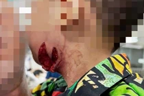 Nghỉ hè về quê, trẻ hơn 2 tuổi bị chó cắn nghiêm trọng 