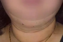 Tự ý dùng thuốc, người phụ nữ bị hội chứng Cushing nguy hiểm