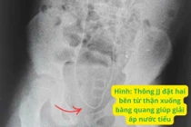 Trẻ 9 tuổi tổn thương thận cấp sau mổ ruột thừa do sỏi niệu quản kẹt