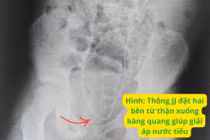 Trẻ 9 tuổi tổn thương thận cấp sau mổ ruột thừa do sỏi niệu quản kẹt