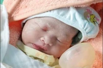 Cứu hai mẹ con thai phụ 35 tuần rau bong non nguy kịch