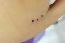 Trẻ 10 tuổi viêm tấy bàn tay do chuột cắn