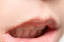 5 món tưởng như vô hại âm thầm làm tăng nguy cơ ung thư miệng