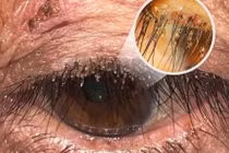 Phát hiện ổ rận mu ký sinh ở mí mắt người phụ nữ