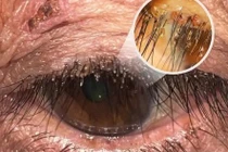 Phát hiện ổ rận mu ký sinh ở mí mắt người phụ nữ