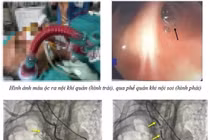 Nút mạch cứu sống bệnh nhân ho ra máu nặng ngừng tuần hoàn