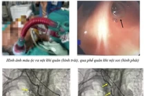 Nút mạch cứu sống bệnh nhân ho ra máu nặng ngừng tuần hoàn